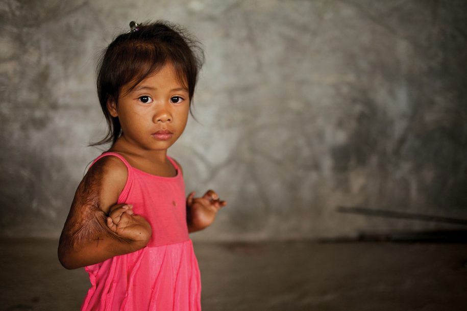 Jocy_before_surgery_at_the_Tebow_CURE_Hospital.jpg